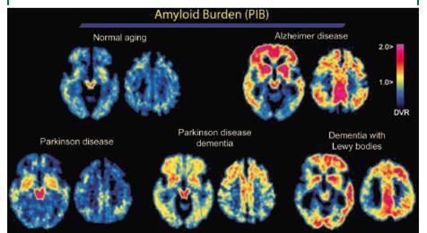 Gomperts Sn et al, Neurology 2008;71:903 910 Longitudinal FUP of PIB- and PIB+ PD will be valuable for ascertaining whether comorbid AD