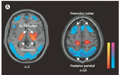 PET-18FDG: Spatial covariance analysis and identification of network abnormalities associated with PD Pattern motorio PDRP Pattern cognitivo PDCP PDRP: Parkinson s