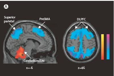 posterior parietal cx proposto come biomarker diagnostico PDCP: Parkinson s disease-related cgnitive pattern Decrease: dorsolateral prefrontal cx (DLPFC), rostral