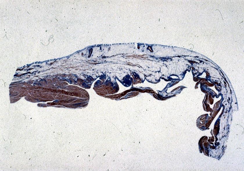 Atrofia miocardica del VD con sostituzione fibroadiposa Mappaggio elettroanatomico