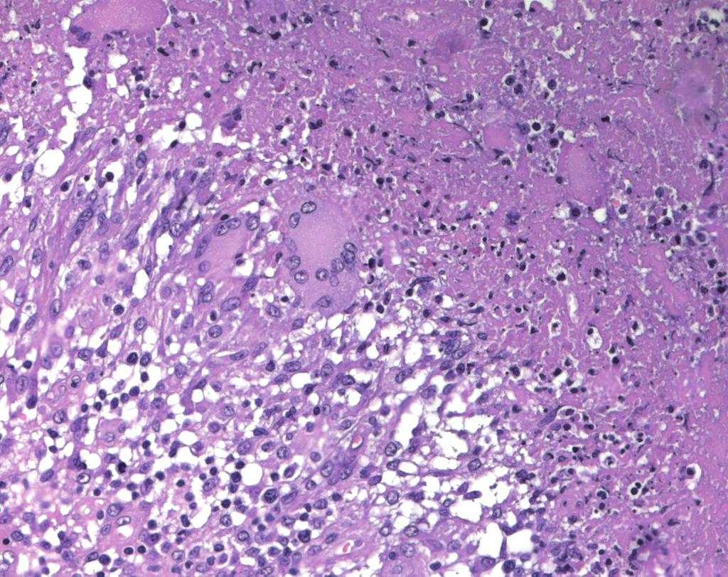 a b c d Figura.6 Linfadeniti granulomatose. Gli aspetti istologici del granuloma possono suggerire l origine della malattia. a) Granuloma tubercolare.