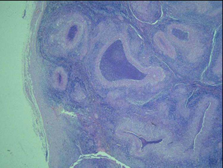 b) Granuloma da graffio di gatto. La necrosi è basofila (blu) e alcuni granulomi hanno forma serpiginosa. c) Linfogranuloma venereo. La necrosi presenta forma stellata. d) Granuloma da corpo estraneo.