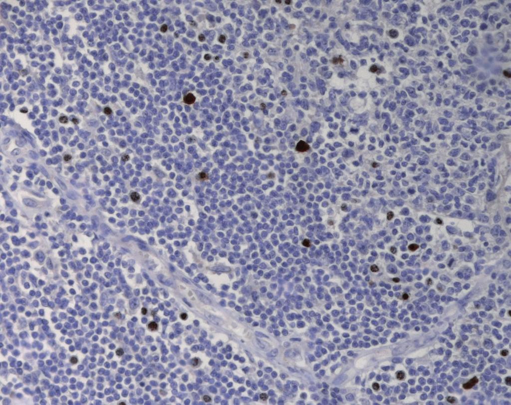 Tuttavia, la rassomiglianza potrebbe essere determinata dalla ricca componente di cellule dendritiche DC-2, attive nella produzione di IFN-α, e probabilmente coinvolte nella patogenesi di entrambe le