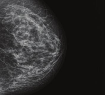 mammografica