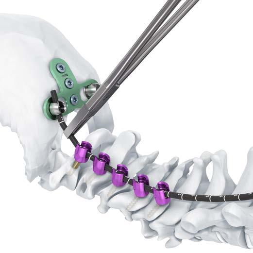 Fissazione occipito-cervicale con placca occipitale 9. Profilare l asta di prova Strumento 388.868 Asta di prova da B 3.5 mm Strumento facoltativo 03.614.