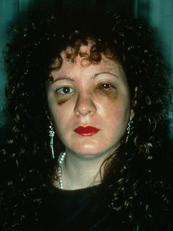 Nan Goldin - Nan one month