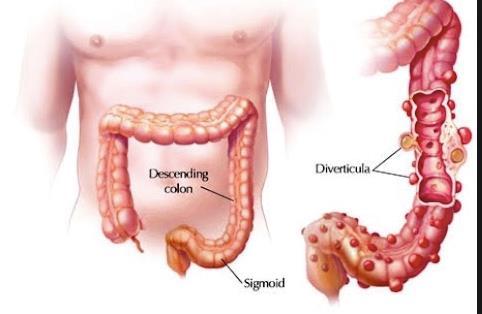 Ricanalizzazione intestinale (Hartmann s reversal) procedura ad elevato grado di complessità ( hostile abdomen )