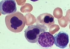 ANEMIA in MDS More than 50% of patients show anemia (Hb < 10 g/dl) at diagnosis More than