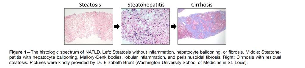 Steatosi epatica non alcolica (NAFLD): Presenza di steatosi epatica in assenza di introito significativo di alcol o altre cause identificabili Hepatic steatosis can occur when there is more than 5%