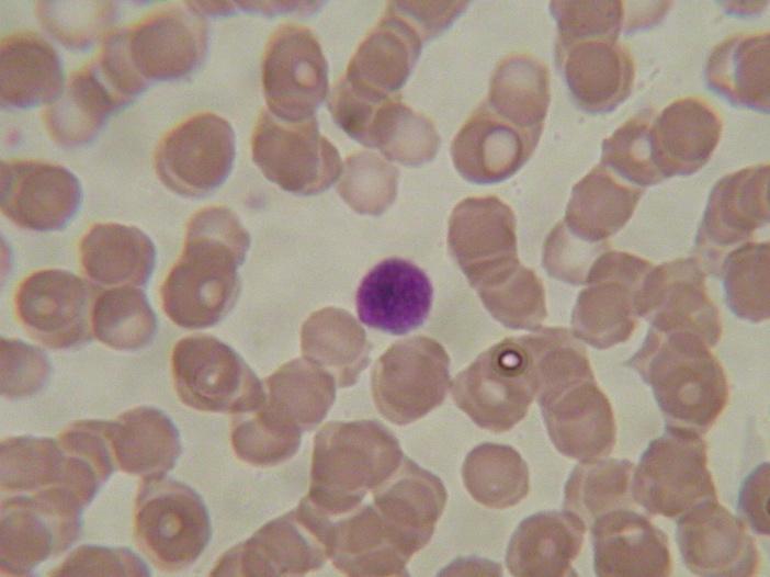 GLOBULI ROSSI (emazie o eritrociti) Non sono vere cellule in quanto non hanno nucleo e