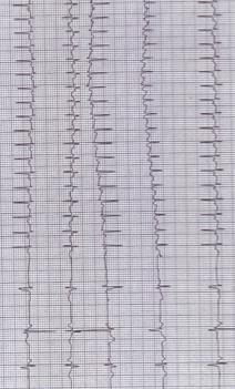 2 Bolo di Adenosina 0,2 mg/kg +