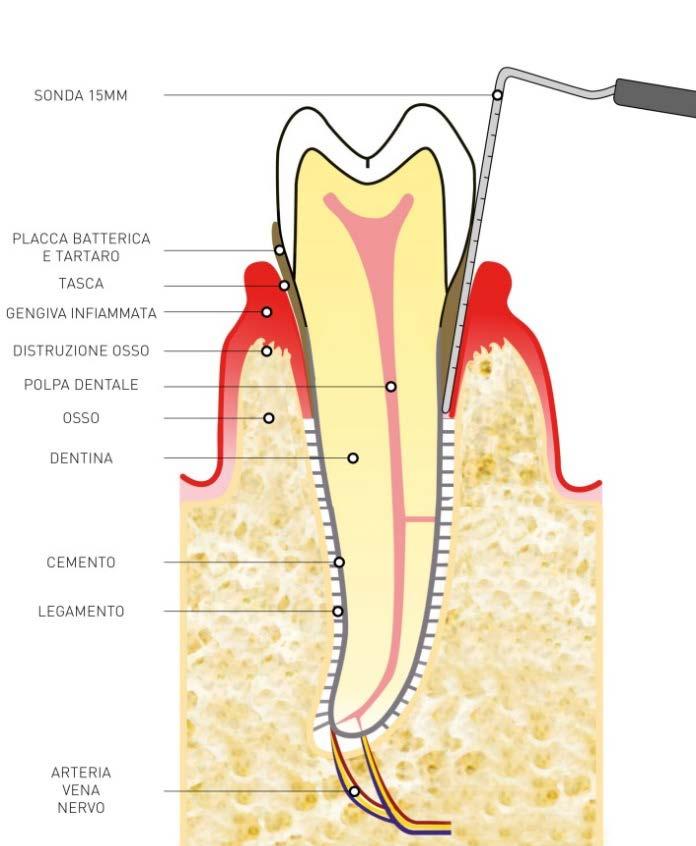 A sinistra. Parodontite iniziale (a): si è verificata una STUDIO modesta distruzione ODONTOIATRICO ossea, di alcuni millimetri a lato della tasca infraossea (vedi la porzione di osso nel rettangolo).