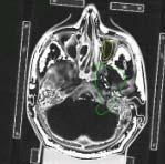 Analisi dell immagine Estrazione di informazioni numeriche o almeno oggettive del contenuto di un immagine Identificazione di oggetti all interno del corpo - elementi con le stesse caratteristiche -