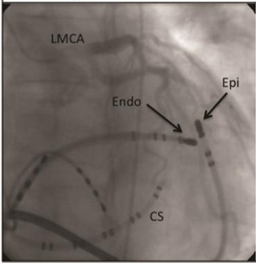 Ablazione per via epicardica Immagine Fluoroscopica In RAO