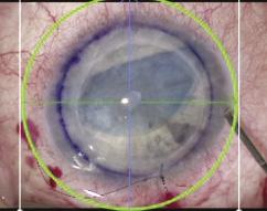 Negli interventi complessi alla cornea lamellare, come la DMEK (Descemet s Membrane Endothelial Keratoplasty, o trapianto di cellule endoteliali corneali) e la DSEAK (Descemet s Stripping Endothelial