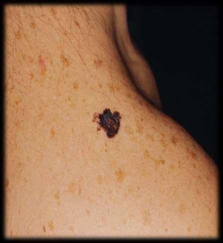 Melanoma