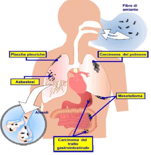 Quali sono gli organi colpiti? e gli effetti prodotti dall esposizione ad amianto?