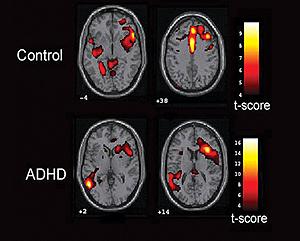 ADHD: Attention Deficit and Hyperactivity Disorder ADHD 200 Data Set: insieme di 1000 immagini fmri di soggetti