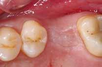 Alla paziente è stato comunicato che sarebbe stato necessario estrarre immediatamente il dente per evitare che l infezione progredisse provocando un ulteriore perdita ossea.
