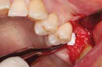 Trascorso tale periodo, avremmo eseguito un esame tomografico per stabilire la tecnica più idonea per l inserimento dell impianto e il successivo restauro del dente.