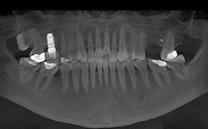 1 Panoramica iniziale ottenuta dalla Cone Beam. Fig. 2 Analisi Cone Beam che mostra la presenza di un altezza ossea di soli 3-4 mm nella regione 26. Fig. 3 Vista occlusale della regione del dente mancante 26.