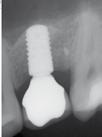 12 Immagine finale dell arcata dentale completa. Fig.