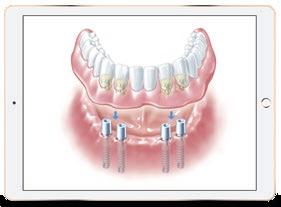 Implantoprotesi Corso avanzato Cod. Mod. IMPL.04 New fixed solutions: no Screw, no Cement 1 Livello RELATORE PARTECIPANTI DURATA ORARIO QUOTA SEDE Prof. Eriberto Bressan Dr. Marco Bambace Odt.