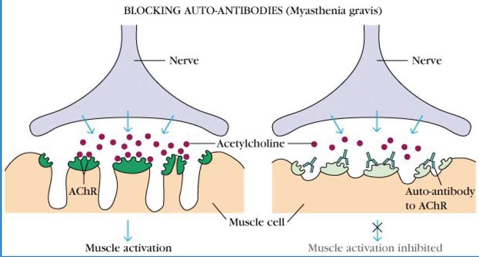 MIASTENIA GRAVIS Sindrome autoimmune determinata da anticorpi specifici per il recettore dell ACh ( riduzione del numero dei recettori funzionanti) o le proteine MuSK (muscle-specific tyrosine