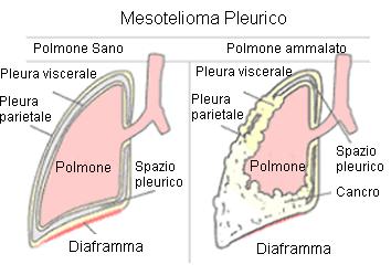 uomini ;1,35 nelle donne frazione di mesoteliomi attribuibili