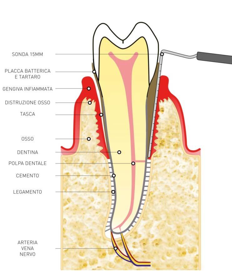 Questo differentemente dalla gengivite pura nella quale, non essendoci stata distruzione ossea le gengive tornano alla loro altezza regolare (vedi immagine in PDF6a: La gengivite).