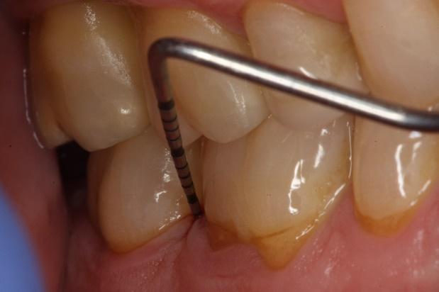 La sonda parodontale scende nella tasca oltre10 millimetri, non fermata da un sano