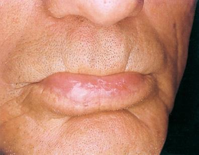 Cheilite attinica (solare) Labbro inferiore Atrofia, squamo-croste