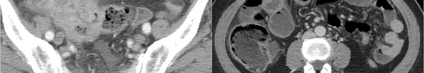 Perforazione intestinale: trattamento L aderenza ai