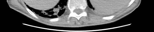 infiammatorioda adenocarcinoma: la