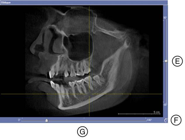 Sirona Dental Systems GmbH Aree di lavoro Area di lavoro "MPR/Radiologia" Piano D La vista D (default: sagittale) può essere adattata a piacere.