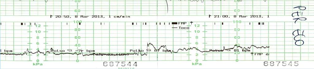 riportano la traccia della fc materna Quando il cardiotocografo non registra in automatico il battito materno,