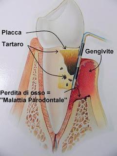 Quali sono le cause della malattia parodontale?