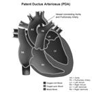 Dotto Arterioso Pervio Fisiopatologia Durante la vita fetale il dotto arterioso permette la comunicazione fra circolazione polmonare e sistemica, e consente