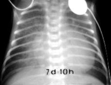 differenziale Dotto Arterioso Pervio Diagnosi Radiografia del