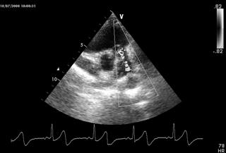 Ecocardiogramma 2 D Color-Doppler Valutazione Morfologica ed