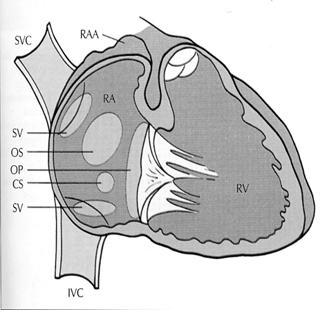 Anatomia Pervietà forame ovale DIA