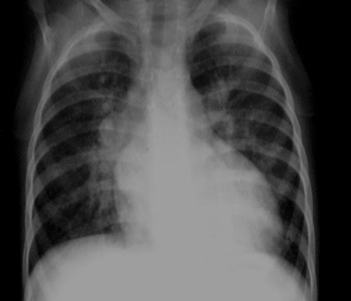 CAV Completo: Ascoltazione Soffio olosistolico al mesocardio irradiato a sbarra (DIV) Soffio sistolico alla punta o in sede parasternale sn-dx bassa (rigurgito valvola AV) Soffio sistolico eiettivo