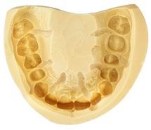 La variante Soft ha una durezza finale ridotta (Shore-A 60) per facilitare ulteriormente la rimozione dal cavo orale.