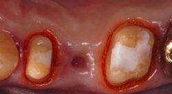 Applicazione Identium Heavy / Identium Light Produzione di un'impronta simultanea 1 Scelta del portaimpronta Nell'arcata superiore si determina la larghezza sul Tuber maxillae e nell'arcata inferiore