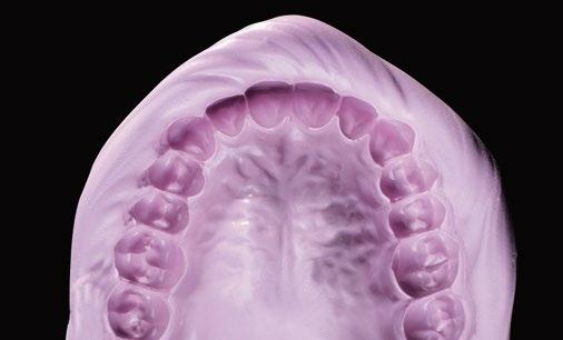 Impronta anatomica Silicone A Silginat Silginat è un silicone A elastomerico a viscosità media nella cartuccia grande 5:1, sviluppato appositamente per la sostituzione dell'alginato (quali ad es.