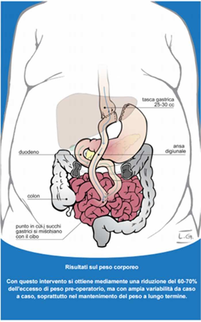 Pag 3/ 5 BYPASS GASTRICO L intervento classico consiste nella creazione di una piccola tasca gastrica che non comunica con il resto dello stomaco, ma viene direttamente collegata all intestino tenue