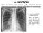 LINFONODI Sono un reperto assai frequente nella Tubercolosi primaria; interessano generalmente i linfonodi dell ilo destro ed i paratracheali.