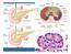 Pancreatite acuta. Forma Lieve (80%) Forma Grave (20%) rapida risoluzione, assenza di complicazioni