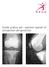 Guida pratica per i pazienti operati di artroprotesi del ginocchio