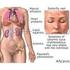 Lupus Eritematoso Sistemico (LES)